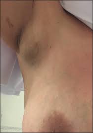 Adenopatía axilar por cáncer de mama.