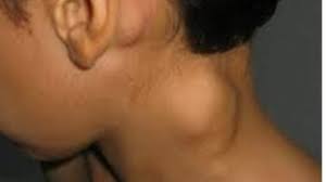 Adenopatías cervicales por enfermedad de Hodgkin.