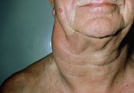 Adenopatías cervicales por enfermedad de Hodgkin.