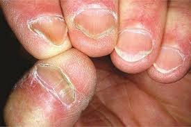 Tengo anemia, ¿qué debo hacer?