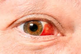 Hematoma escleral. No necesariamente se debe a una enfermedad hematológica. Se puede presentar por trombocitopenia o por esfuerzo o tos.