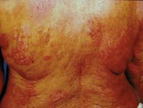 Micosis fungoide (linfoma cutáneo).
