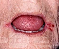 Queilitis angular. Se observa en anemia, especialmente en la anemia ferropénica.
